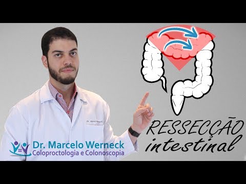 Vídeo: Ressecção Do Intestino Grosso: Finalidade, Procedimento E Riscos