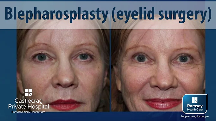 What is Blepharoplasty with Dr Nicholas Lotz