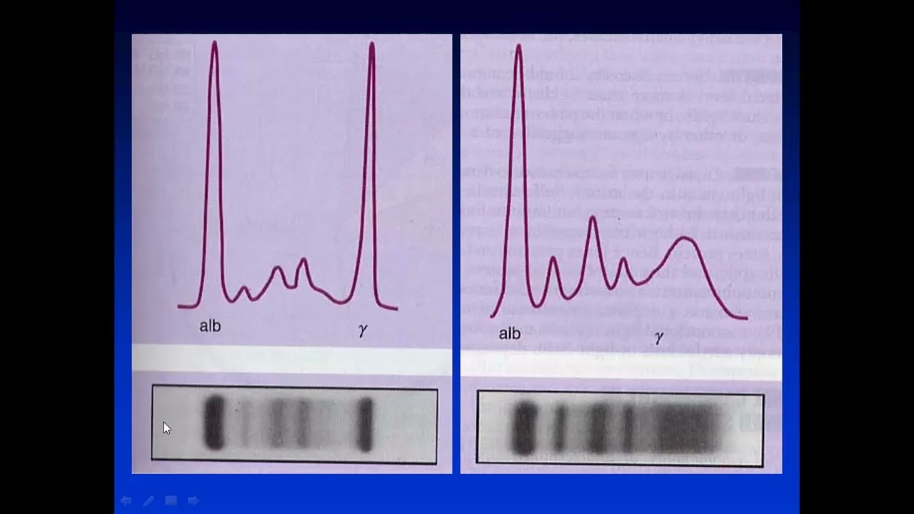 UT15 - Mieloma Prof  Dra  Fernández