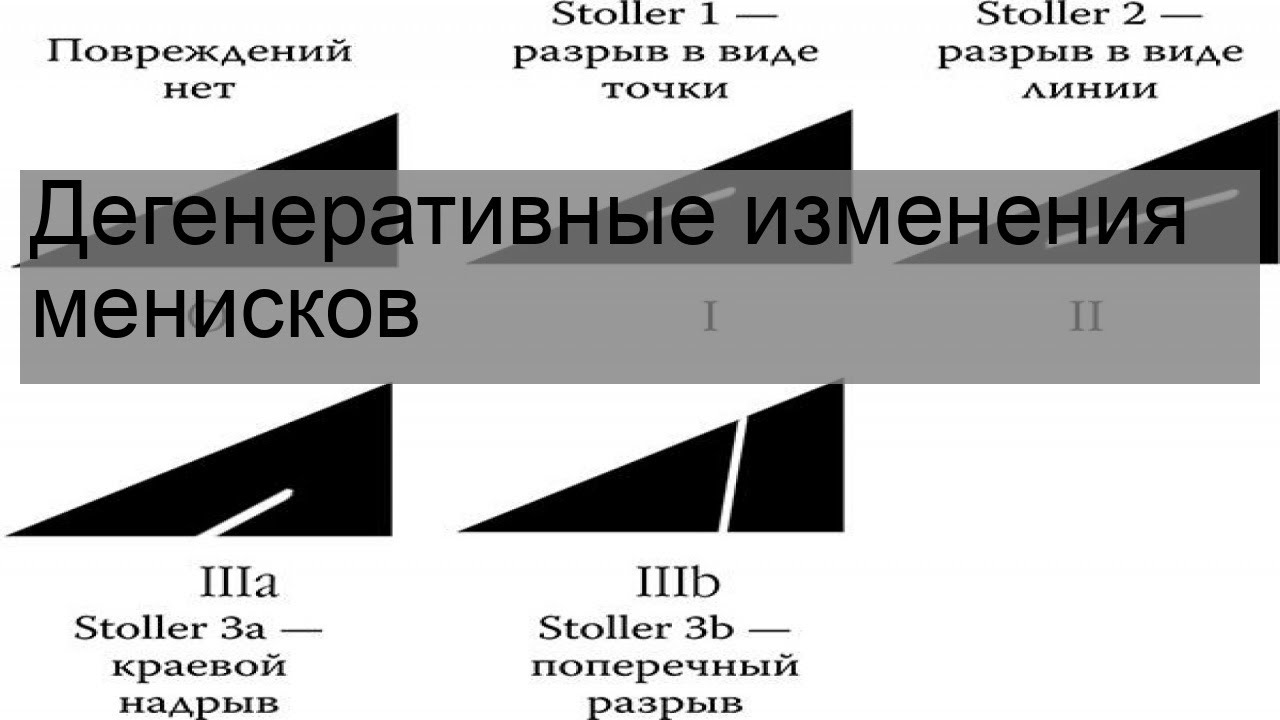 Разрыв мениска степени по stoller