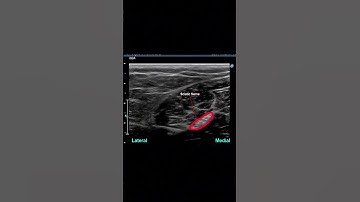 Sciatic Nerve Block #anesthesia #ultrasound #anesthesiology #regionalanesthesia anes