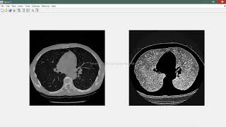 Gaussian windowing Matlab || Medical image processing [2]