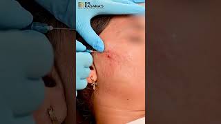 Subcision for Acne Scars | Acne Scar Treatment | Cheek Acne Scar Removal | Dr Pooja Kasana
