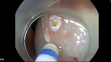 ESD Hang vị phía măt sau