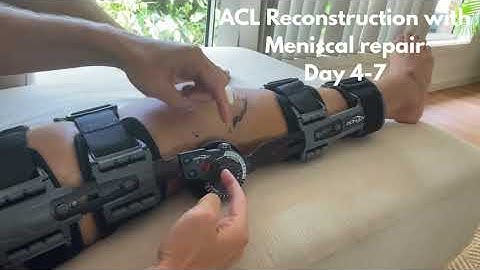 ACL reconstruction with meniscal repair Day 4-7