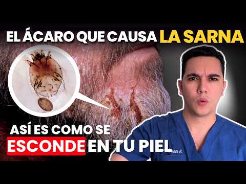Sarna (escabiosis): cómo reconocerla, cómo se contagia y cómo eliminarla
