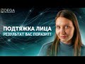 Платизмопластика до и после. Периорбитопластика до и после. Реальный отзыв пациента!