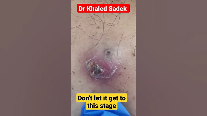 Red Hot #cystremoval Dr Khaled Sadek #blackheads