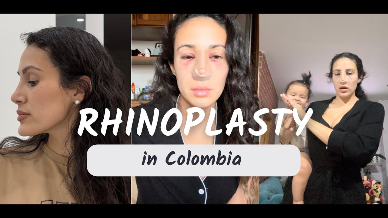 I went to Colombia for a Rhinoplasty (before and after pics, daily videos, experience, pain and more