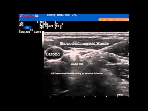 Lumbar transforaminal epidural steroid injection video