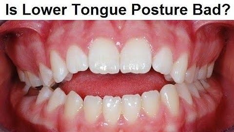 Why Tongue Can`t Stay Touching Lower Front Teeth by Prof John Mew