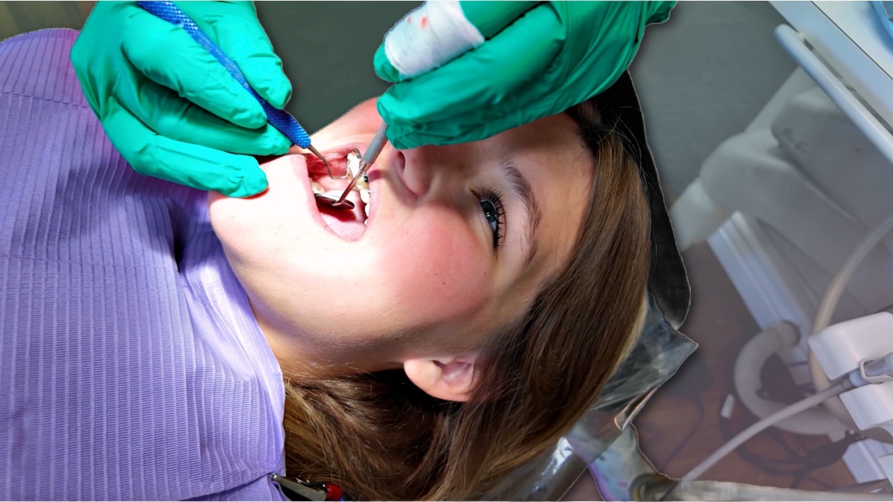 WHO Had the MOST CAViTiES?!