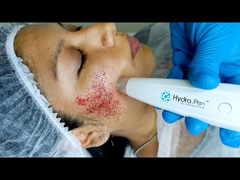ELIMINAR CICATRICES de ACNE con HYDRAPEN? 🔴 Microagujas? 🤔 #dermapen