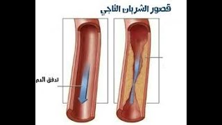 علاج قصور الشريان التاجى - الذبحة الصدرية بالحجامة د محمود شعراوي