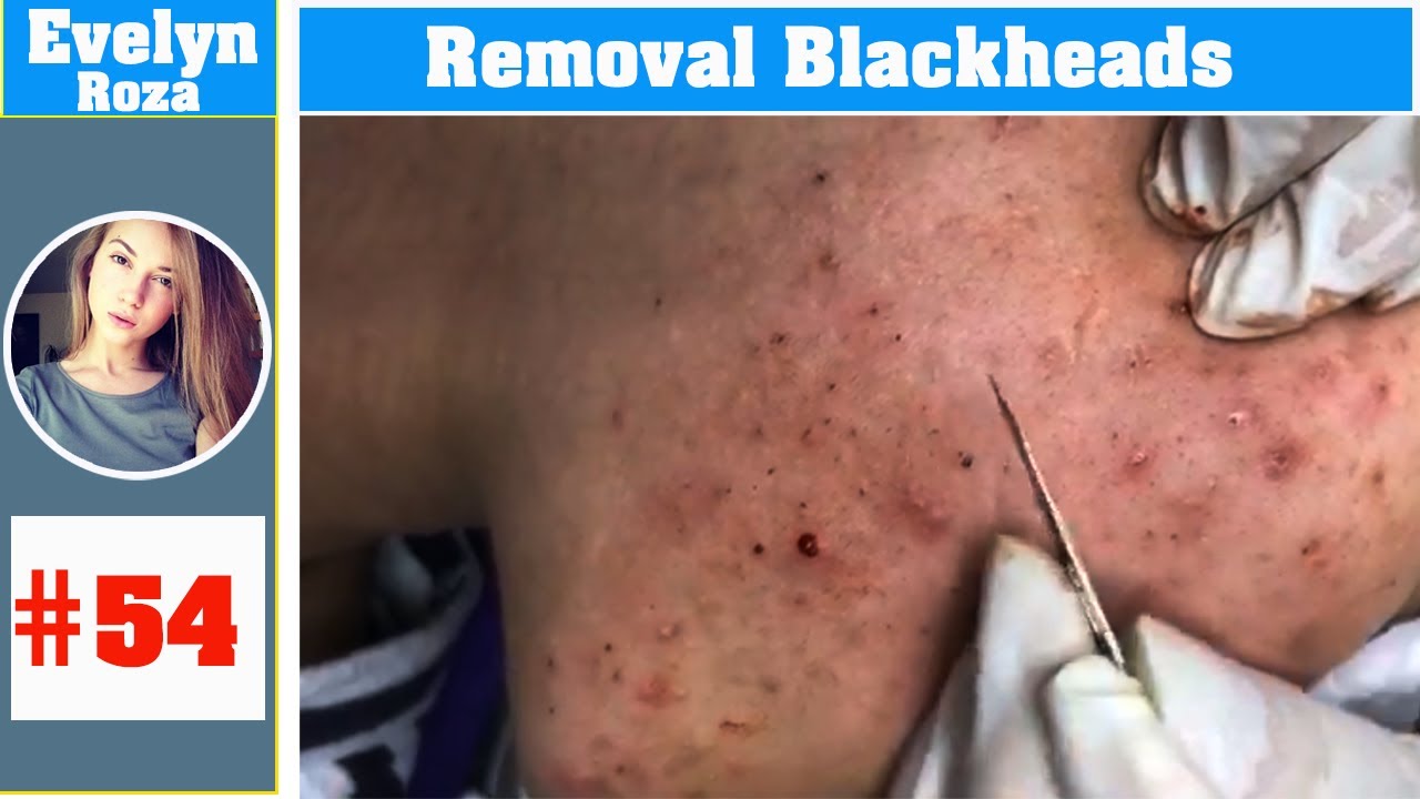 Acne hidden and Blackhead easily removal - Acne Treatment (#54)