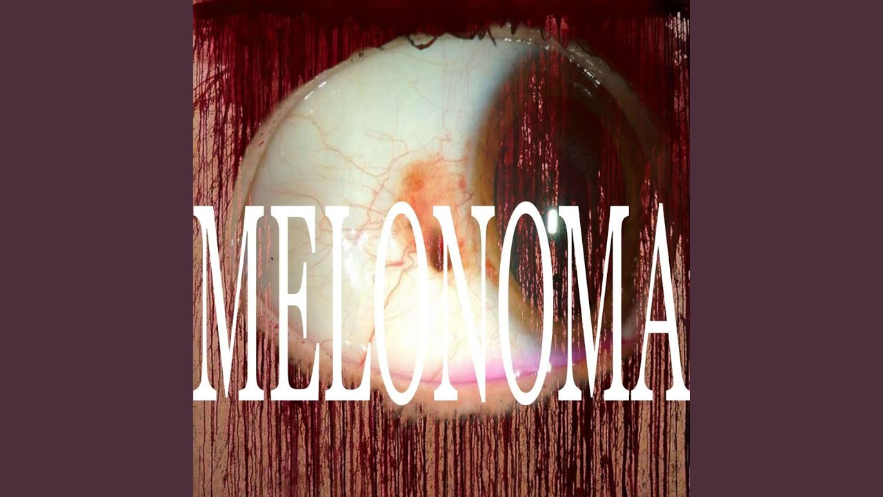 Watch MELONOMA on YouTube Watch MELONOMA on YouTube