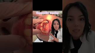 Expansión maxilar con ortopedia