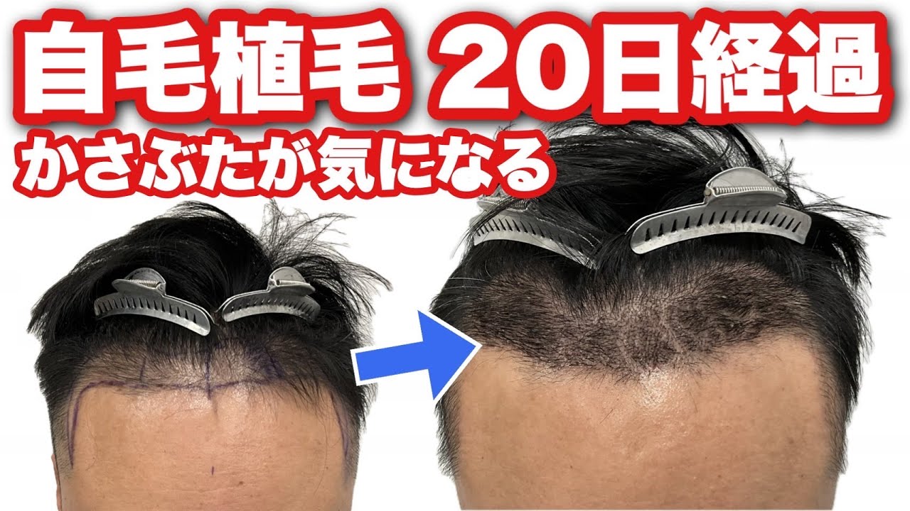 Hair Transplant Progress: 20 Days Post-Op for a Man in His 40s