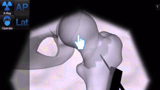 Bonedoc - Placing the guidewire