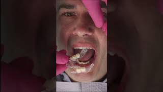 Clear Dentures ! Amazing new Sprintray Retainer resin.