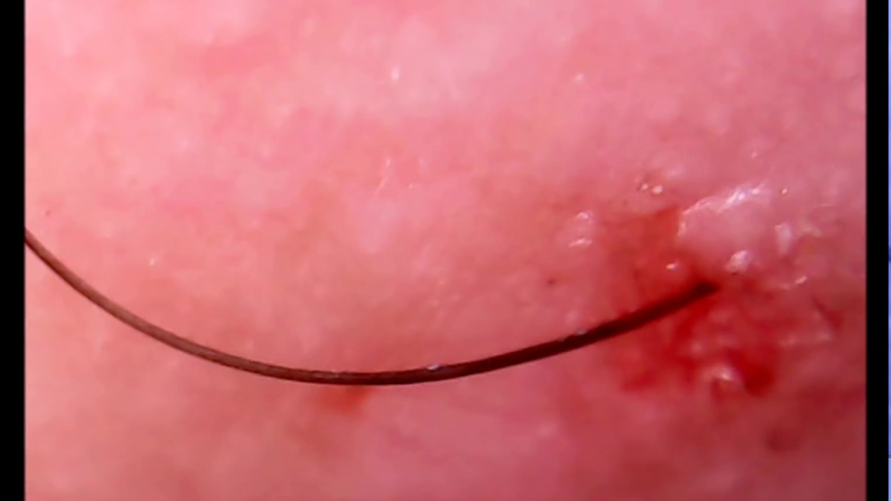 Removal Of An Ingrown Hair From My Neck YouTube