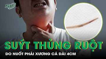 Người Đàn Ông Suýt Thủng Dạ Dày Vì Nuốt Phải Xương Cá Dài 4cm I SKĐS