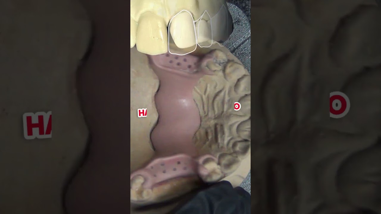 INYECTANDO PEEK CON MINI MUFLA #dentaduras #dientes #peek #protesisdental #dental #protesista