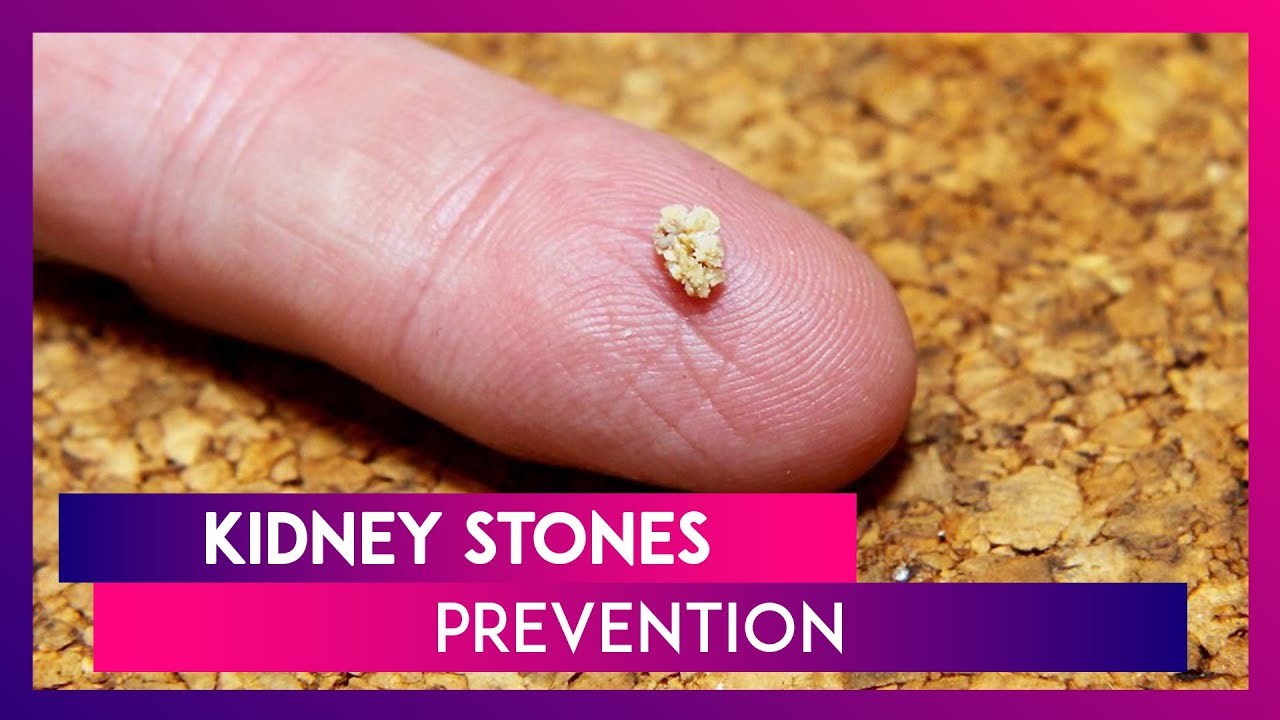 What Are Different Types Of Kidney Stones