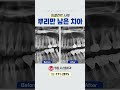 뿌리와 보철물 머리부분이 분리되어 있던 환자분의 임플란트 사례 [명동 시스템치과]
