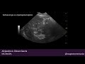 Ultrasonido de hepatitis enfisematosa, ruptura de vesícula, litiasis migrada y peritonitis biliar.