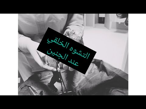 التشوه الخلقي عند الجنين أسبابه وكيفاش نتفاداوه      