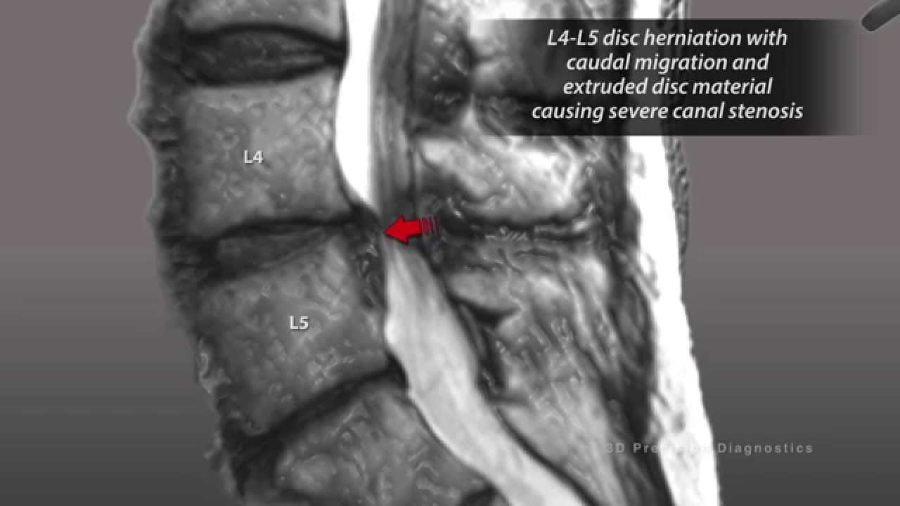 3d Precision Diagnostics Lumbar Spine Injuries Mri Youtube