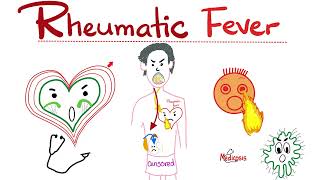 Rheumatic Fever  Jones Criteria  Causes, Signs, Symptoms, Diagnosis & Treatment  Cardiology