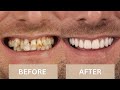 Before  after smile makeover transformations  dental boutique