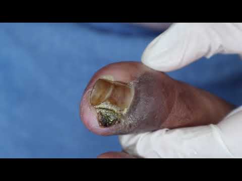 Ep_2594 Toenail removal 👣 อุปสรรคของน้อง..อยู่ที่แผล 😷 (This clip is from Thailand)