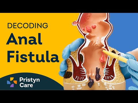 Difference between Piles and Fistula and How to Prevent it? - Dr Chintan B.  Patel