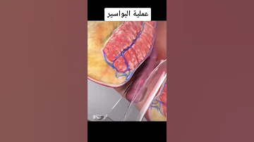 عملية البواسير 