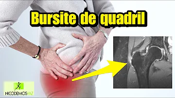 Qual o sintoma de bursite no quadril?