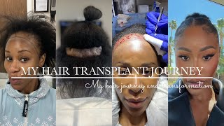 MY HAIR TRANSPLANT  JOURNEY: Overcoming Challenges, Embracing my Natural hair!