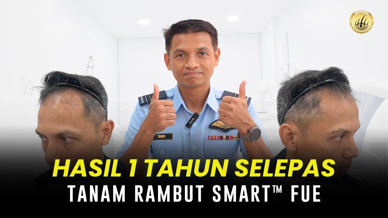1 Year Post-SMART™ FUE Hair Transplant Results at GLOJAS Specialist Clinic #hairtransplantmalaysia