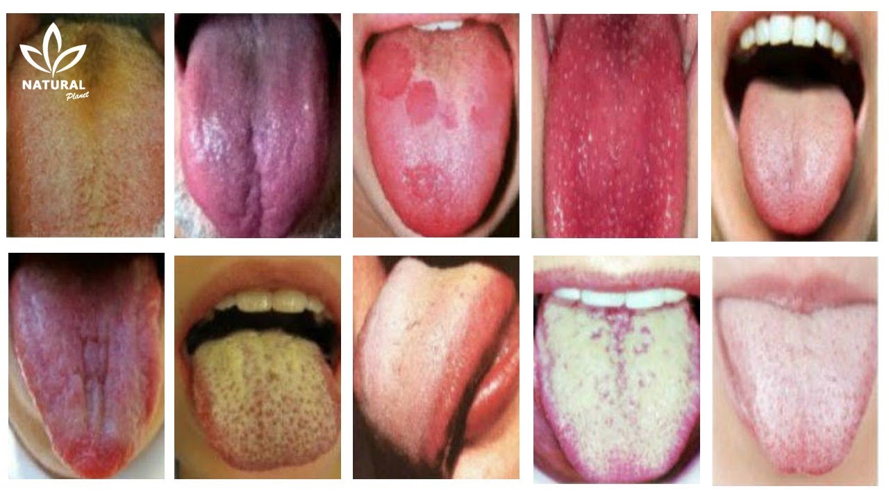 what does a healthy tongue look like