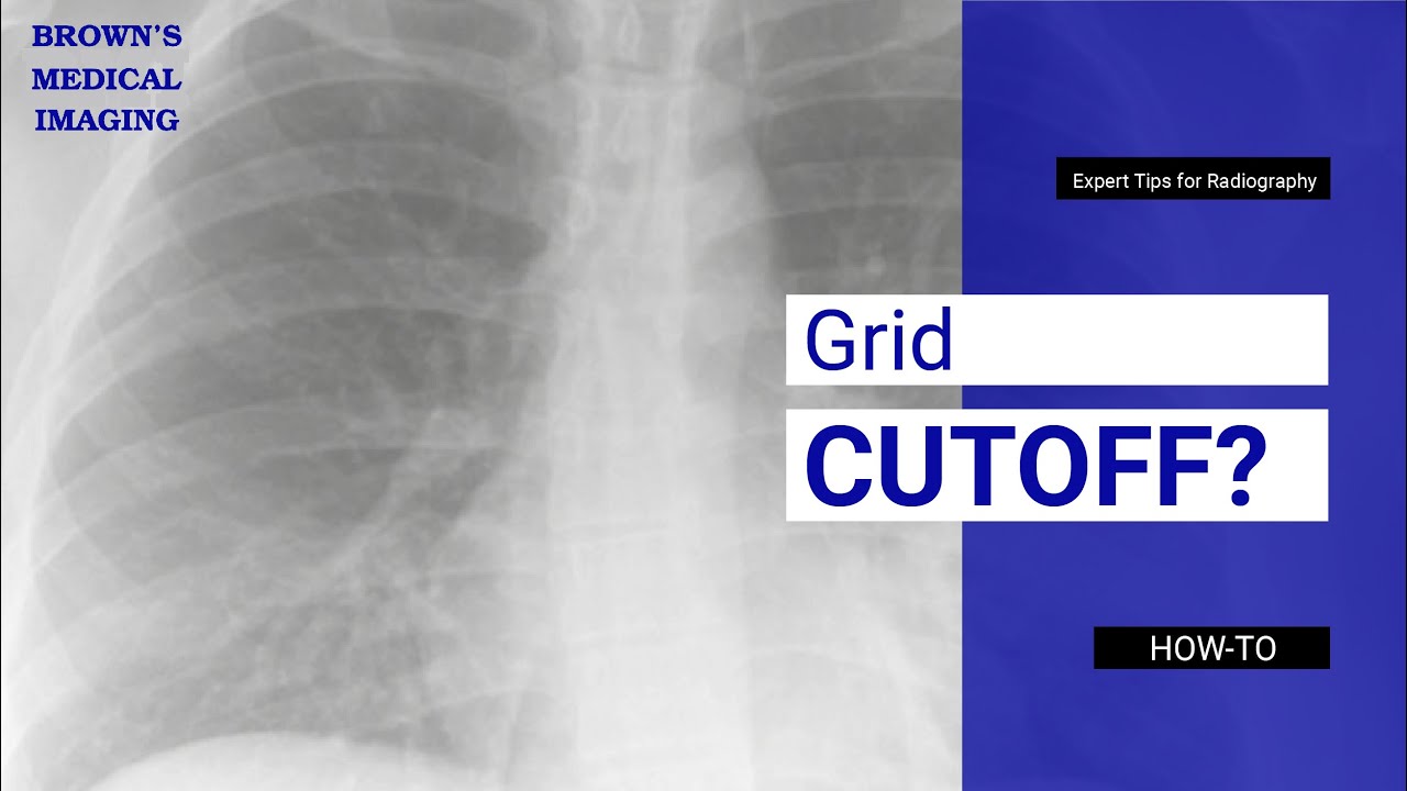 Grid Cutoff No Problem Expert Tips For Perfect Radiography Images Grid Cutoff No Problem Expert Tips For Perfect Radiography Images