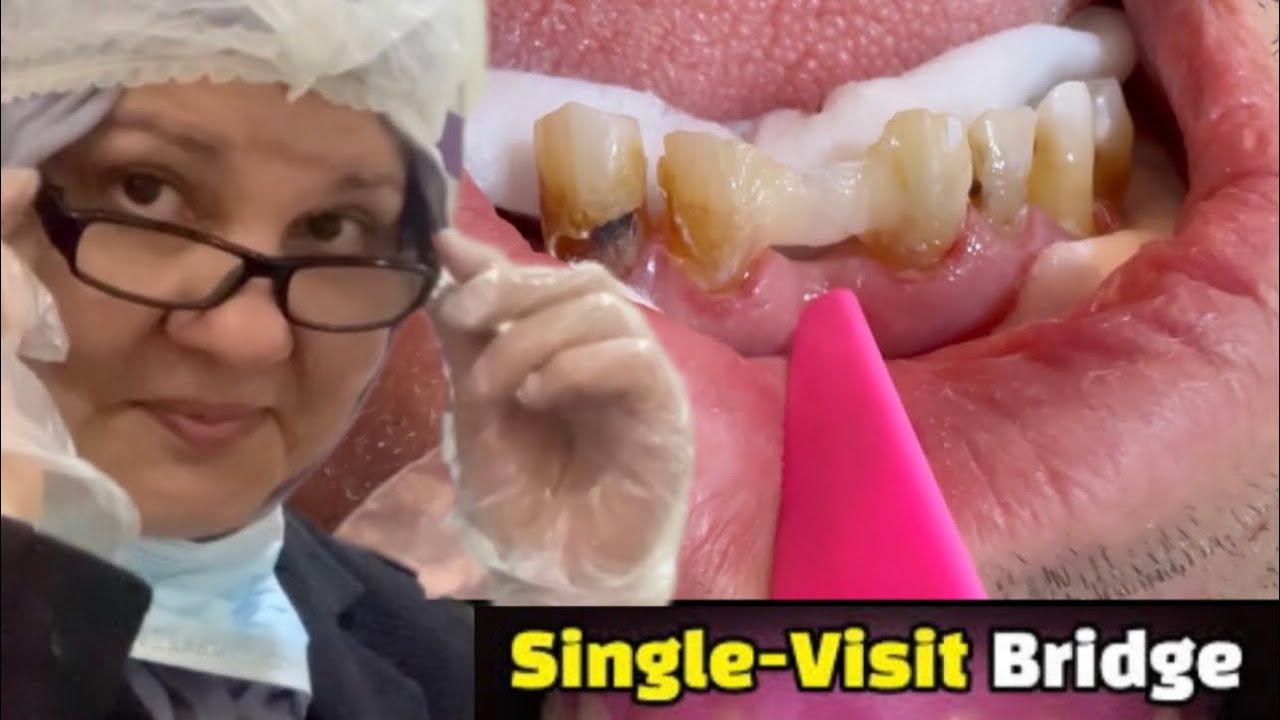 single visit bridge ribbond bridge best dentist in erbil best dental clinic in erbil dr. dina
