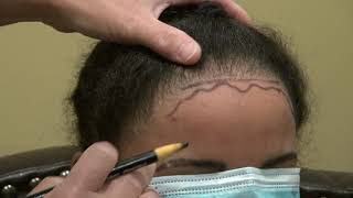 Dr. Diep Attempts to Repair Bad Black African Woman Hair Transplant Surgery from Different Clinic