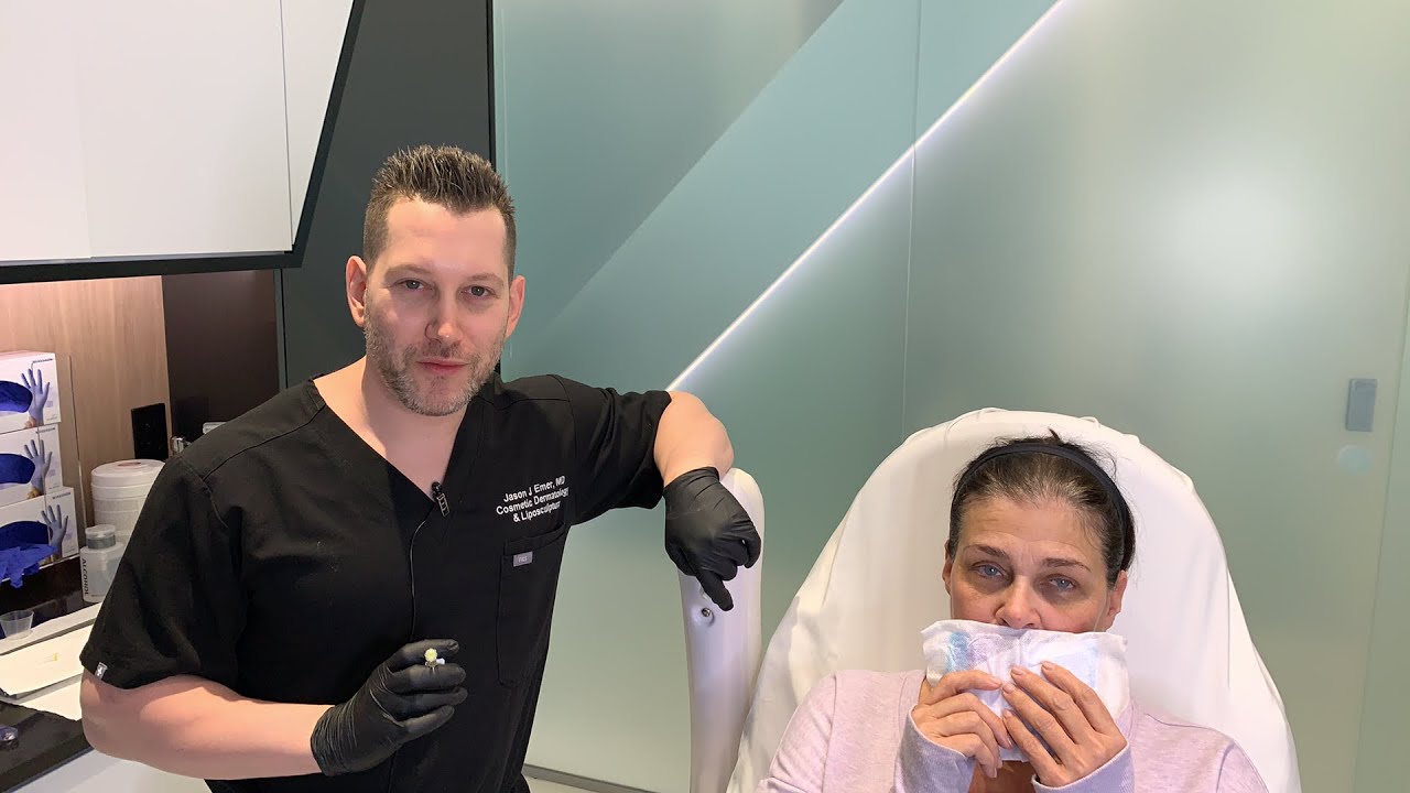 Female Facial Sculpting with Belotero | Smoker's Lines and Lip Rejuvenation | West Hollywood, CA
