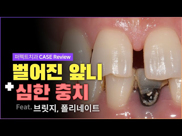 벌어진 앞니 무삭제라미네이트 / 심한 충치 발치 후 브릿지로 해결❗