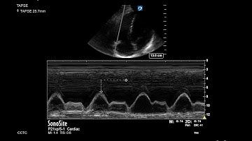 How to... Measure TAPSE