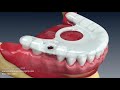 Dental Implant Animation