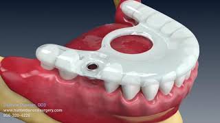 Dental Implant Animation