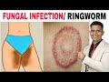 Get Rid Of Ringworm Naturally | Fix Fungal Infection Naturally - Dr. Vivek Joshi